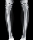 Leg x-ray image