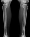 Leg x-ray image