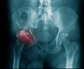 X-ray image hip avascular necrosis Royalty Free Stock Photo