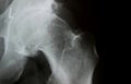 X-Ray image of hip bone with degeneration of the joint Coxarthrosis Royalty Free Stock Photo