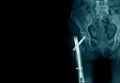 X-ray image hip fracture or intertrochanteric fracture and post internal fixation Royalty Free Stock Photo