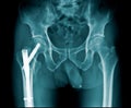 X-ray image hip fracture or intertrochanteric fracture and post internal fixation Royalty Free Stock Photo