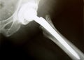 X-Ray image of hip with implanted artificial joint replacement Endoprosthesis in case of coxarthrosis joint degeneration Royalty Free Stock Photo