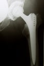 X-Ray image of hip with implanted artificial joint replacement Endoprosthesis in case of coxarthrosis joint degeneration