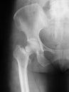 X-ray image of hip joint, AP view, preoperative.