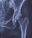 X-ray image of hip joint with signs of coxarthrosis Royalty Free Stock Photo