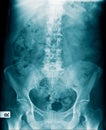 X-ray image of human abdomen, picture of human spine and pelvic bone show degenerative change of spine