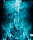 X-ray image of human abdomen Royalty Free Stock Photo