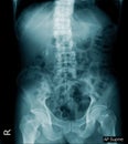 X-ray image of human abdomen, picture of human spine and pelvic bone show degenerative change of spine Royalty Free Stock Photo