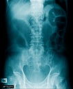 X-ray image of human abdomen, picture of human spine