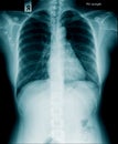 X-ray image of human abdomen, picture of human spine Royalty Free Stock Photo