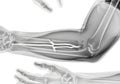 X-ray image of human arm bones Royalty Free Stock Photo