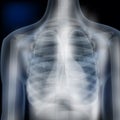 X-Ray Image Of Human Chest Medical Diagnosis