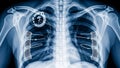 An X-ray image of a human chest with a pacemaker and stents Royalty Free Stock Photo