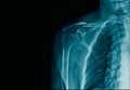 X-ray image clavicle fracture