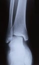 X-ray image of human foot joint , back view Royalty Free Stock Photo