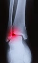 X-ray image of human foot joint Royalty Free Stock Photo