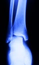 X-ray image of human foot joint Royalty Free Stock Photo