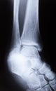 X-ray image of human foot joint , side view Royalty Free Stock Photo
