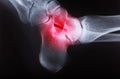 X-ray image of human foot joint Royalty Free Stock Photo