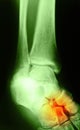 X-ray image of human foot joint