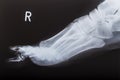 X-ray image of human foot Royalty Free Stock Photo