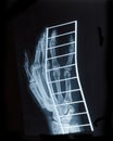 X-Ray image of human hand a fracture on the metal support