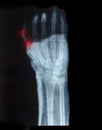 X-Ray image of human hand with little fingers shown red