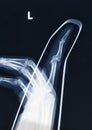 X-Ray image of human hand with stick Royalty Free Stock Photo