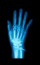X-Ray image of human hands Royalty Free Stock Photo