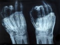 X-Ray image of human hands Royalty Free Stock Photo