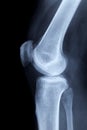 X-ray image of a human knee laterally Royalty Free Stock Photo