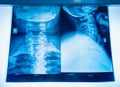 X-Ray Image of human neck for a medical diagnosis. Royalty Free Stock Photo