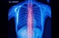 X-ray image of human spinal column