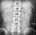 X-ray image of the human spine Royalty Free Stock Photo