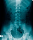 x-ray image of human spine and pelvic