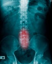 X-ray image of human spine and pelvic