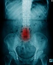 X-ray image of human spine and pelvic