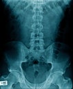 X-ray image of human spine and show lumbar spondylosis Royalty Free Stock Photo