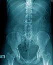 X-ray image of human spine and show lumbar spondylosis Royalty Free Stock Photo