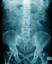 X-ray image of human spine and show lumbar spondylosi Royalty Free Stock Photo