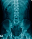 X-ray image of human spine Royalty Free Stock Photo