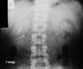 X-ray image of IVP(Intravenous Pyelogram)