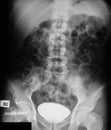 X-ray image of IVP, supine view.