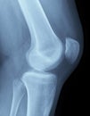 X-Ray image of a knee Royalty Free Stock Photo