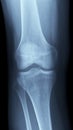 X-Ray image of a knee Royalty Free Stock Photo
