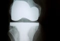 X-Ray image of knee with complete artificial joint replacement Endoprosthesis in case of arthrosis joint degeneration