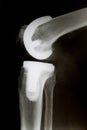 X-Ray image of knee with complete artificial joint replacement Endoprosthesis in case of arthrosis joint degeneration Royalty Free Stock Photo