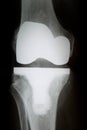 X-Ray image of knee with complete artificial joint replacement Endoprosthesis in case of arthrosis joint degeneration Royalty Free Stock Photo