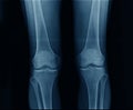 X-ray knee both side Royalty Free Stock Photo
